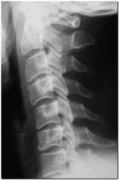 Emakakaela lülisamba röntgen