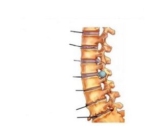 Osteokondroosi sümptomid