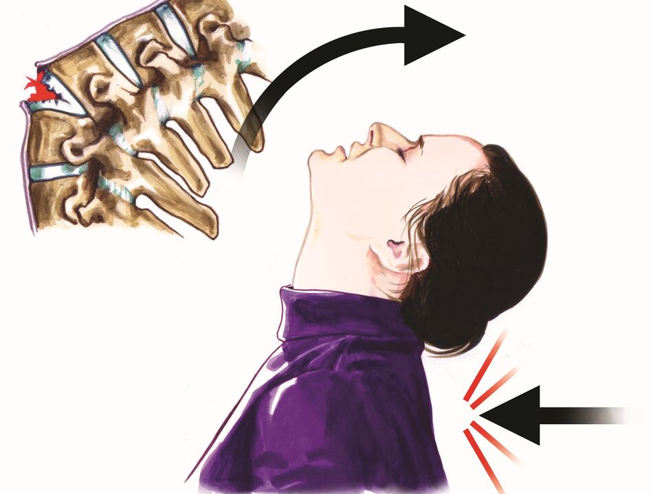 lülisamba kahjustus kui kaelavalu põhjus